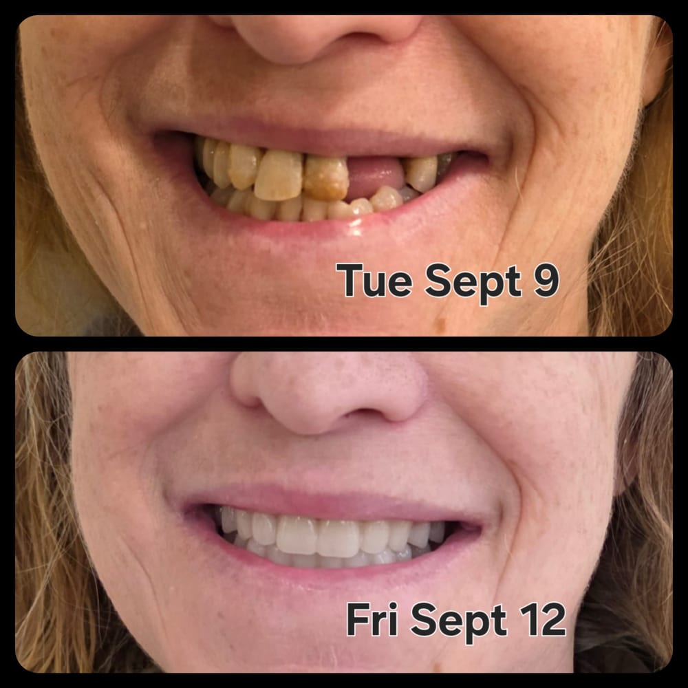 Before and after immediate dentures, from Main Denture Clinic on Instagram