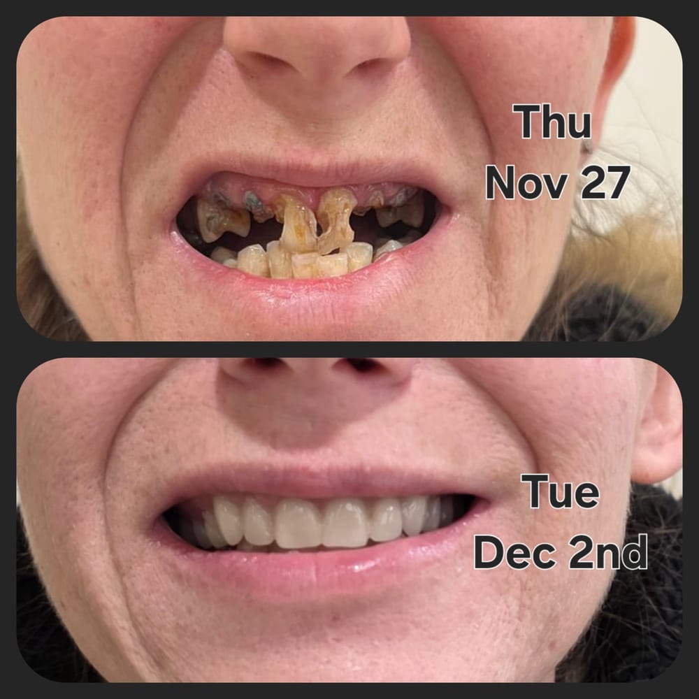 Before and after an immediate full upper denture, from Main Denture Clinic on Instagram