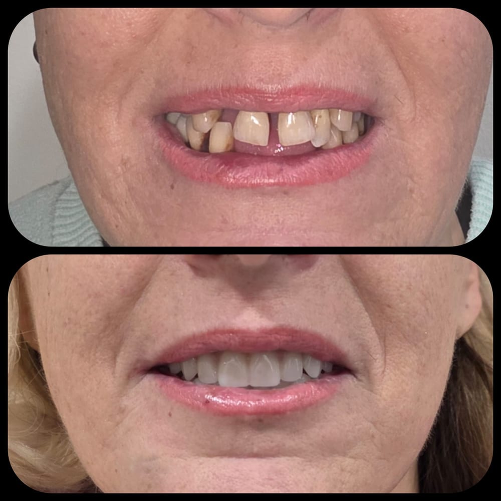 Before and after immediate dentures following full extractions, from Main Denture Clinic on Instagram