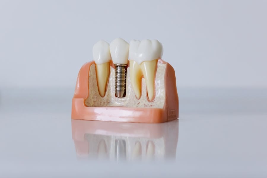 Implant Secured Dentures
