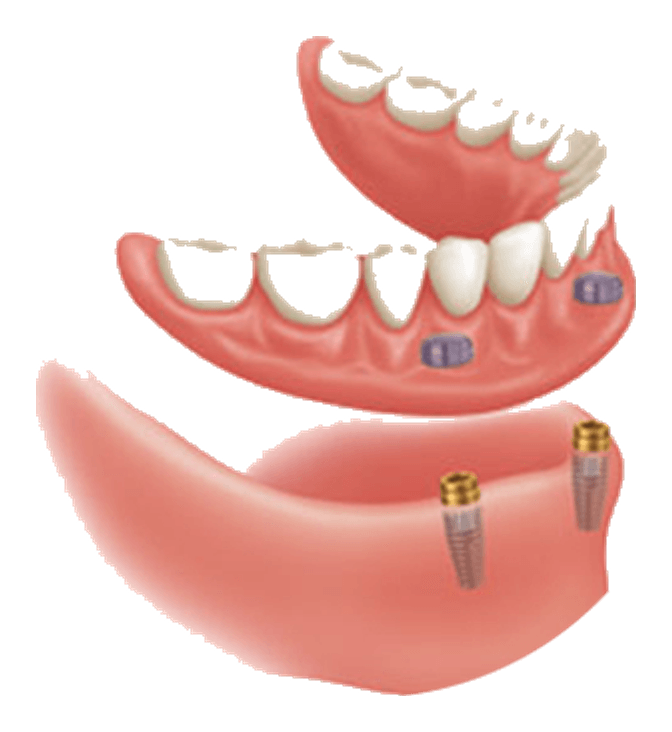 Implant Secured Dentures made at Main Denture Clinic